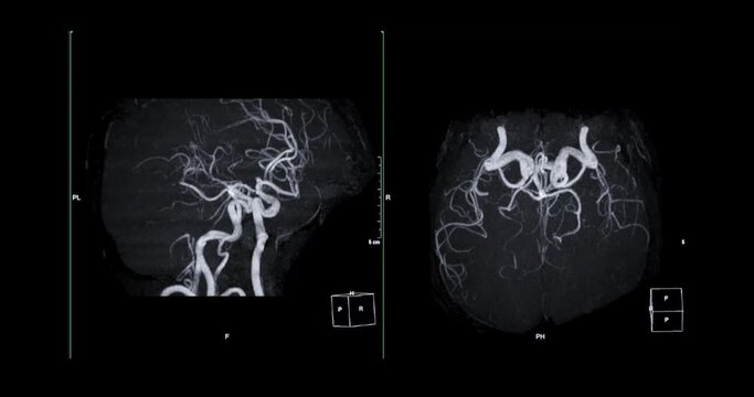 MRA Brain or Magnetic resonance angiography of Cerebral artery turn around on the screen. MRA Brain MIP view for evaluate cerebral artery.
