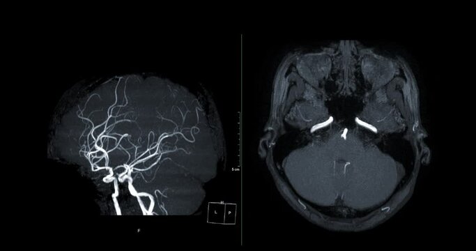 MRA Brain or Magnetic resonance angiography of Cerebral artery turn around on the screen. MRA Brain MIP view for evaluate cerebral artery.
