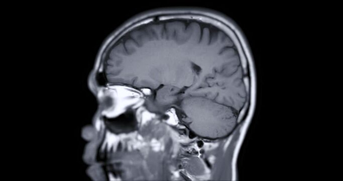 MRI of the brain or magnetic resonance imaging of the brain showing brain anatomical..