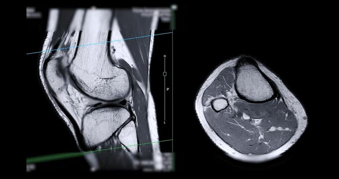 MRI knee or Magnetic resonance imaging of knee joint   for detect acl ligament tear.