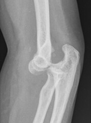 x ray of a elbow dislocation,broken elbow
