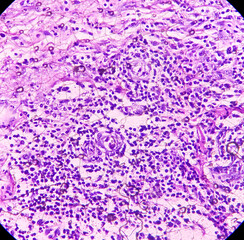 Pilonidal disease, pilonidal sinus tract, microphotograph of Compatible with sinus tract, show sinus tract lined by granulation tissue and infiltration of inflammatory cells.