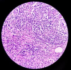 Pilonidal disease, pilonidal sinus tract, microphotograph of Compatible with sinus tract, show sinus tract lined by granulation tissue and infiltration of inflammatory cells.