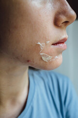 Woman's face after chemical peeling. Peeling skin on the face. Exfoliation of old skin problems, acne, blackheads.