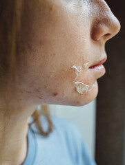 Woman's face after chemical peeling. Peeling skin on the face. Exfoliation of old skin problems,...