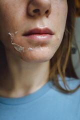 Woman's face after chemical peeling. Peeling skin on the face. Exfoliation of old skin problems,...
