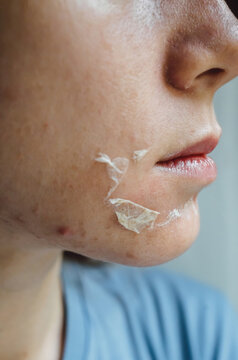 Woman's face after chemical peeling. Peeling skin on the face. Exfoliation of old skin problems, acne, blackheads.