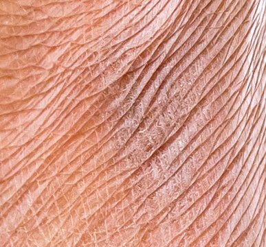 closeup rough dehydrate dry human skin texture.