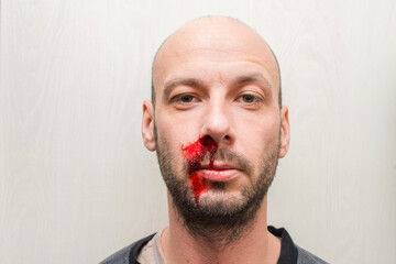 Portrait of a man with a badly broken nose. The guy is bleeding from his nose. Blood on the face of an unshaven man. © Климов Максим