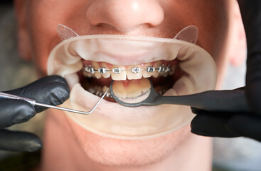 Macro photography of man's mouth with metal braces and cheek retractor. Dentist's hands in rubber gloves making teeth check up with dental tools. Cropped image. Top view. Oral hygiene concept