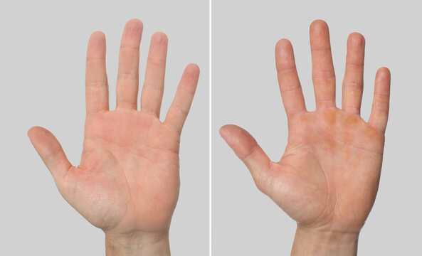 Man showing hands without and with calluses on light grey background., closeup. Collage