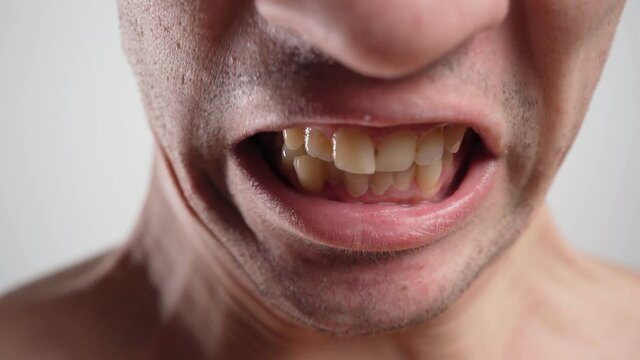 Close-up, a Man Shows his Crooked Yellow and Unhealthy Teeth. Dental Care Concept. 