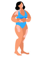 Vector graphics - a beautiful girl stands in a blue swimsuit isolated on a white background with spots on her skin - diagnosis - vitiligo. Concept - body positive