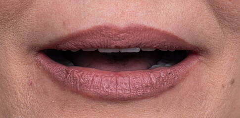 teeth indirect restoration by ceramic crowns and veneers