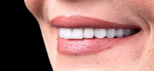 teeth indirect restoration by ceramic crowns and veneers