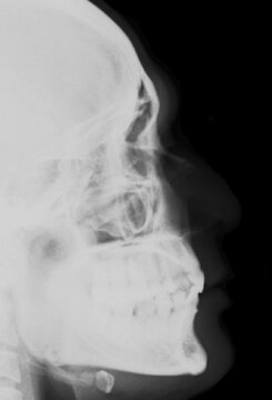 X Ray Image Of Skull,broken Nose,fracture Nasalis