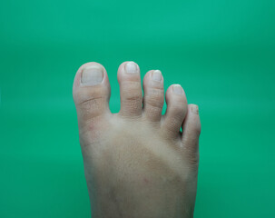 The tip of the right toe with long nails, and the surface of the foot that looks sunburned.