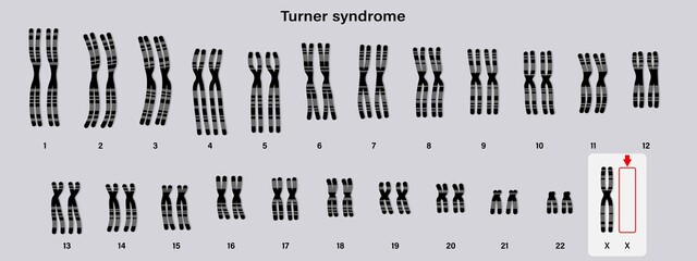 Human karyotype of Turner syndrome. One of the X chromosomes (sex chromosomes) is missing or partially missing. 45,X, or 45,X0. - obrazy, fototapety, plakaty