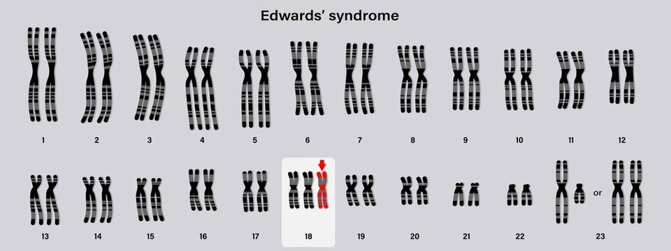 Human karyotype of Edwards' syndrome. Autosomal abnormalities. Trisomy 18. Genetic disorder.