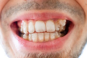 orthodontic invisible braces on crooked ugly teeth close-up. Ugly smile. Dental concept, medicinal...