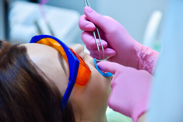 Woman patient with protective glasses and retractor for teeth whitening procedure