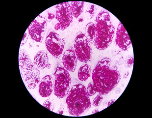 Gram staining, also known as Gram's method, is a method of differentiating bacterial species into two large groups (Gram-positive and Gram-negative). Here, Occasinal gram positive cocci are seen. 40X