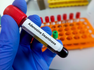 Biochemist hold blood sample for the testing of serum ADA level. Adenosine deaminase.