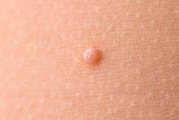 Detail of a molluscum contagiosum nodule produced by the Molluscipoxvirus virus on the skin of the...
