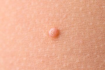 Detail of a molluscum contagiosum nodule produced by the Molluscipoxvirus virus on the skin of the abdomen of a child.