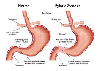 Medical illustration of symptoms of pyloric stenosis - obrazy, fototapety, plakaty