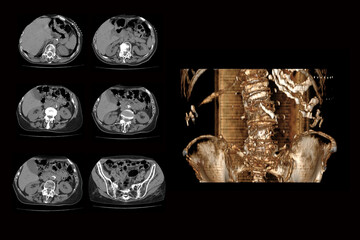 computed tomography of the spine with a fracture of the vertebrae and their displacement from a...