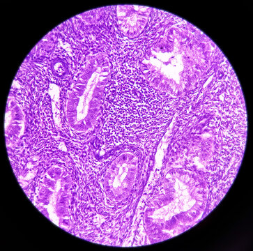 Cervicitis Bilder – Durchsuchen 272 Archivfotos, Vektorgrafiken und ...
