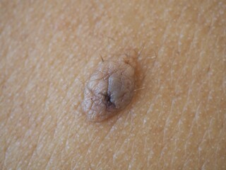 Big black mole on the back. health concept. closeup photo, blurred.