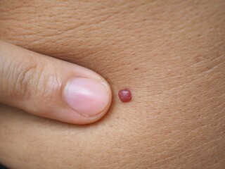 Man points a finger at a large mole on her abdomen. closeup photo, blurred.