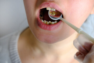 dentist, doctor examines oral cavity of female patient, uses mouth mirror, closeup teeth young...