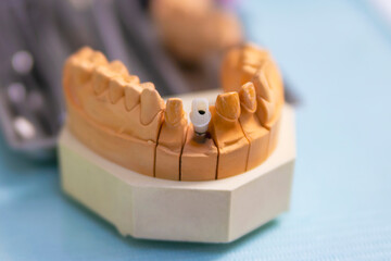 Dental prosthesis for implant.