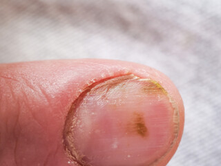man finger nail fungus disease