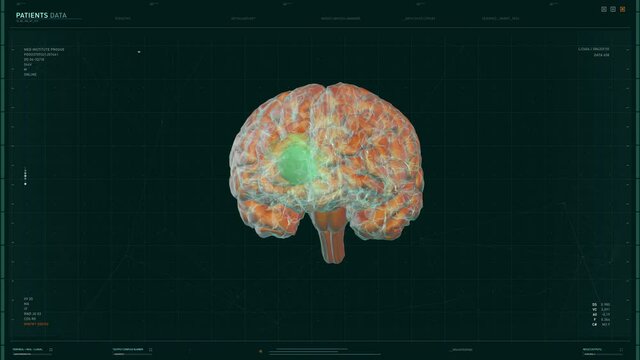 Brain Tumor Diagnosis Showing On A High Tech Computer Program Interface. Confirming Diagnosis On MRA Scan Interface. Diagnosis Interface Checking A Brain Focusing On A Tumor Diagnosis
