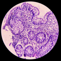 Ileum histology, Chronic granulomatous inflammation histologically consistent with tuberculosis,...