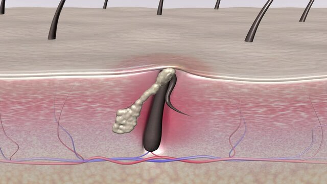 Skin treatment technologies. 4K 3D animation showing inflamed follicles with ingrown hair before and after treating.  