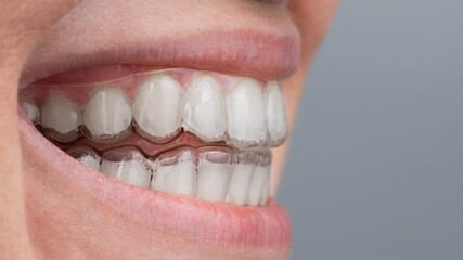 Close-up of a caucasian woman smiling with aligners on her teeth. Macro.