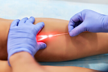 Varicose laser treatment on female legs in clinic
