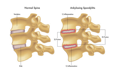 Medical illustration compares a normal spine with one showing the steps leading to ankylosing spondylitis.