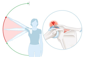 Shoulder impingement. Painful arc. Labeled illustration