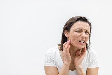 Fototapeta premium Photo of woman having skin problems and feeling bad because of it.