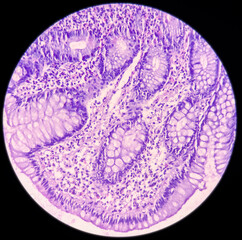 Ileum histology, Chronic granulomatous inflammation histologically consistent with tuberculosis,...