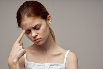 red-haired woman with pimples on the face hygiene light background