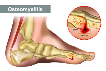 Osteomyelitis is an infection of bone. Diagram shows osteomyelitis of a humans foot bone. Necrotic bone