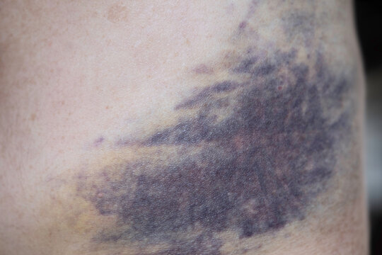 Subcutaneous bruising or hematoma on the side of a human's lower abdomen