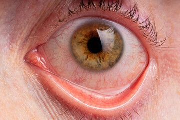 tired brown eye with blood vessels